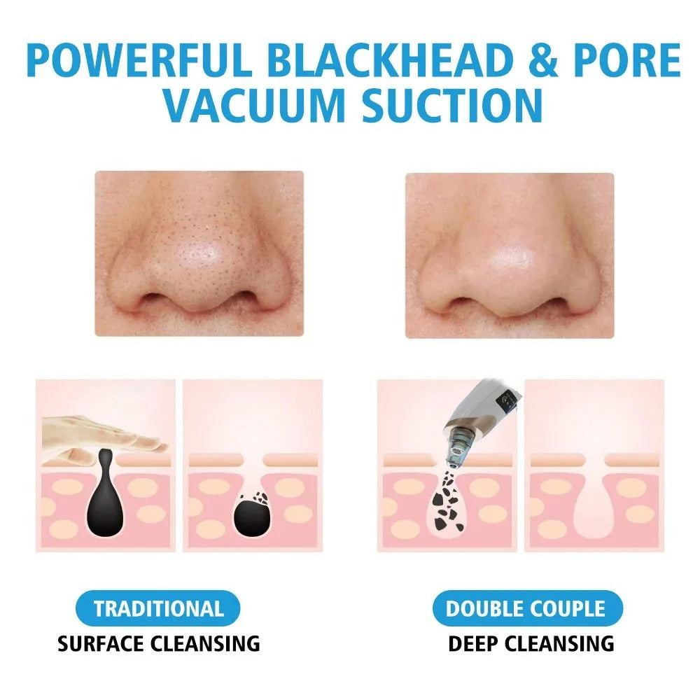 Upgraded Blackhead Remover Vacuum Facial Pore Cleaner Electric Acne Comedone Whitehead Extractor Tool 5 Probes For Women And Men